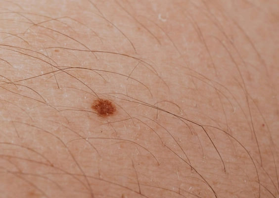 close up image of a small mole on skin