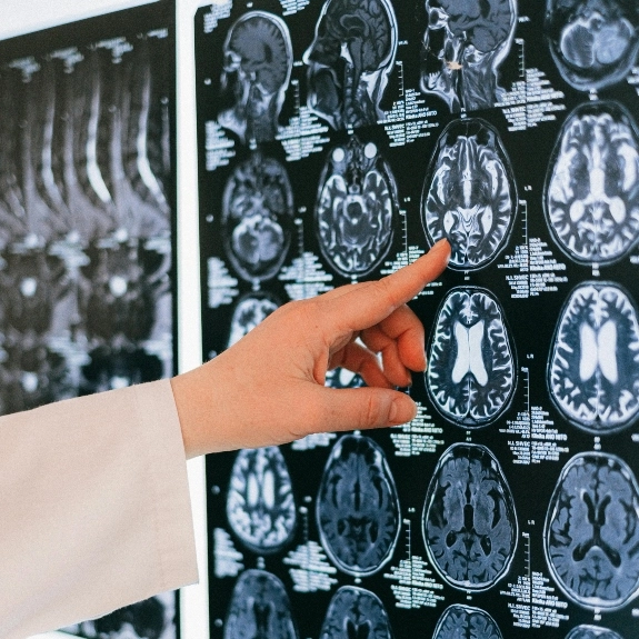 Doctor's hand pointing at a backlit brain scan image.